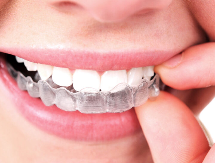 teeth-straighten in slough